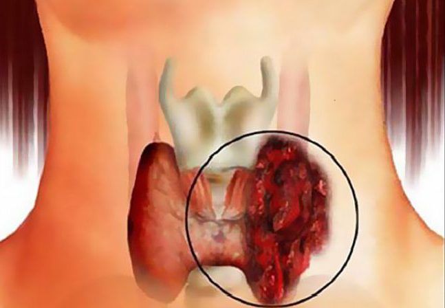 Зоб щитовидной железы. причины, симптомы, диагностика и лечение зоба
