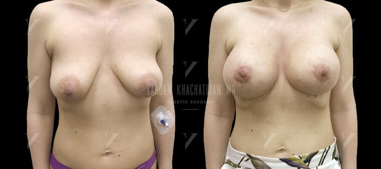 Пластика груди - медицинские показания для проведения операции, виды коррекции и противопоказания