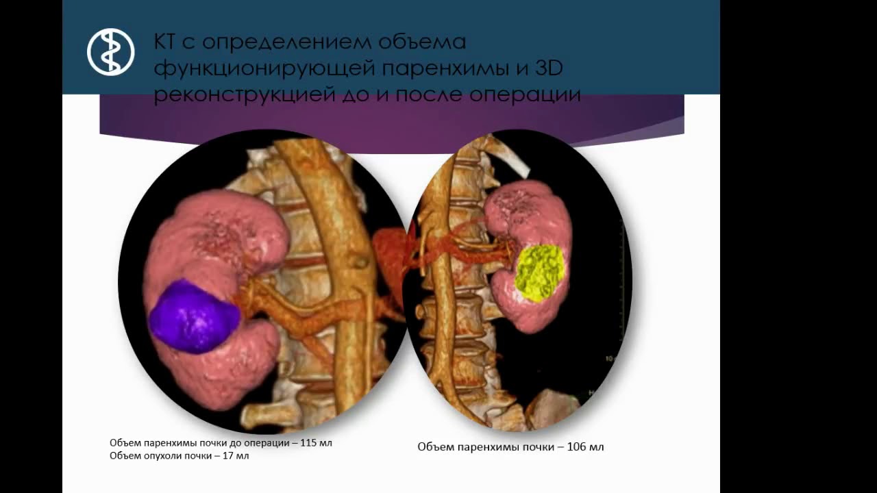 Подковообразная почка у ребенка чем опасна