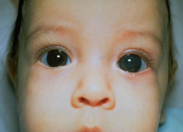 Зрение у новорожденных детей