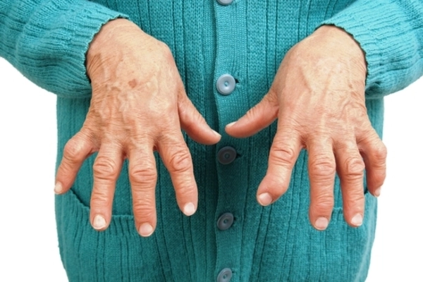 Ревматоидный артрит – причины и лечение воспаления суставов