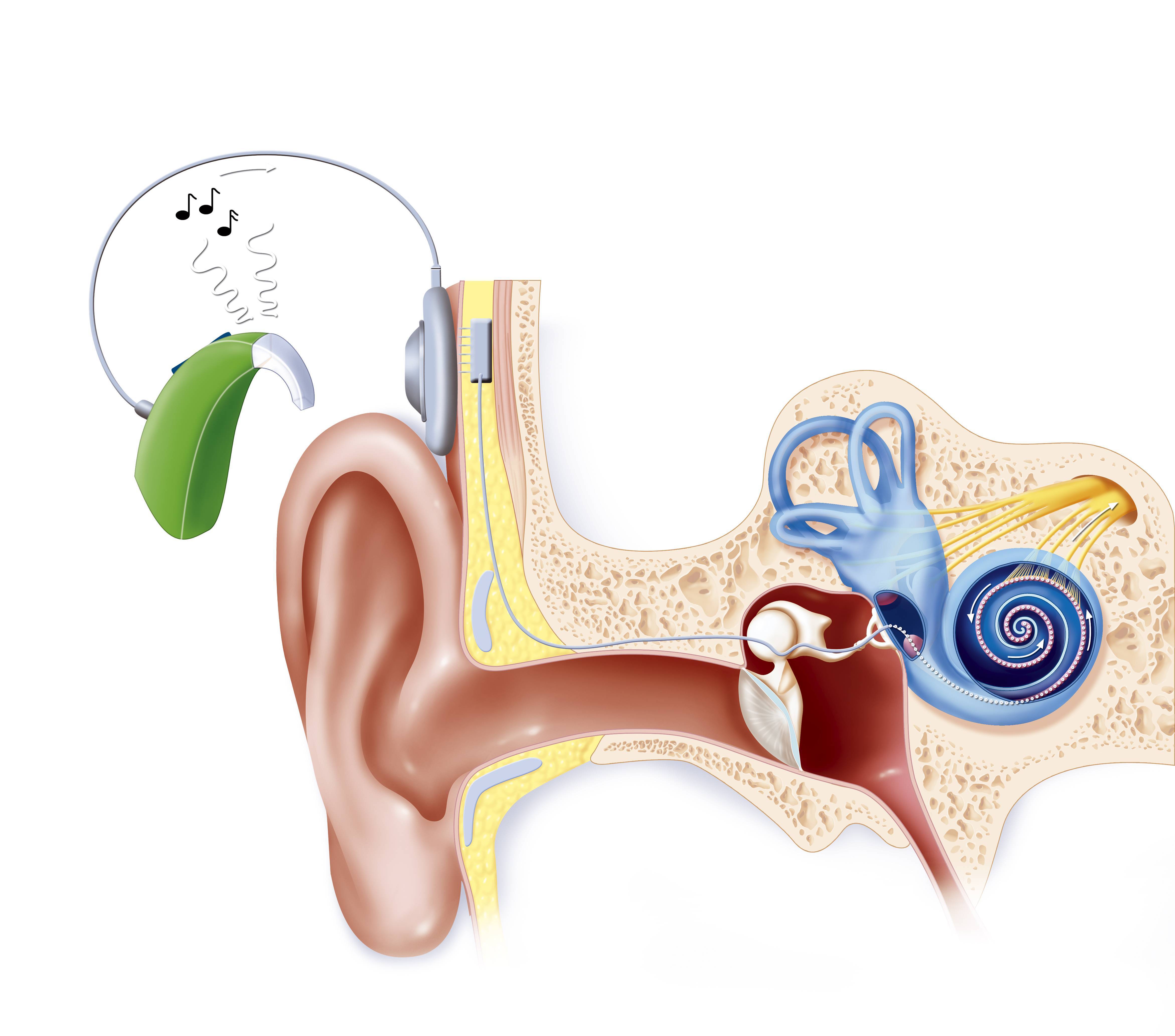 Слуховая система восприятия. Кохлеарный имплантат нейросенсорная тугоухость. Кохлеарный имплант кохлеар. Сенсоневральная тугоухость слуховой аппарат. Кохлеарный неврит барабанная перепонка.