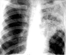 Как отличить пневмонию от туберкулеза легких