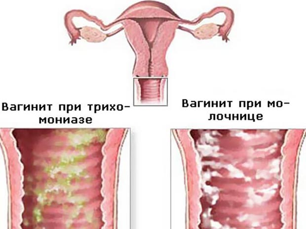 Симптомы и лечение кольпита (неспецифического вагинита)