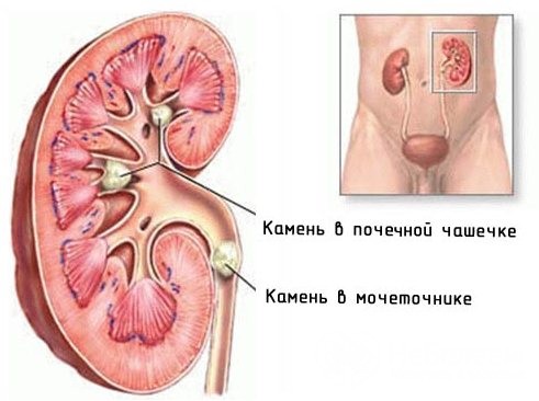 Подковообразная почка у ребенка чем опасна