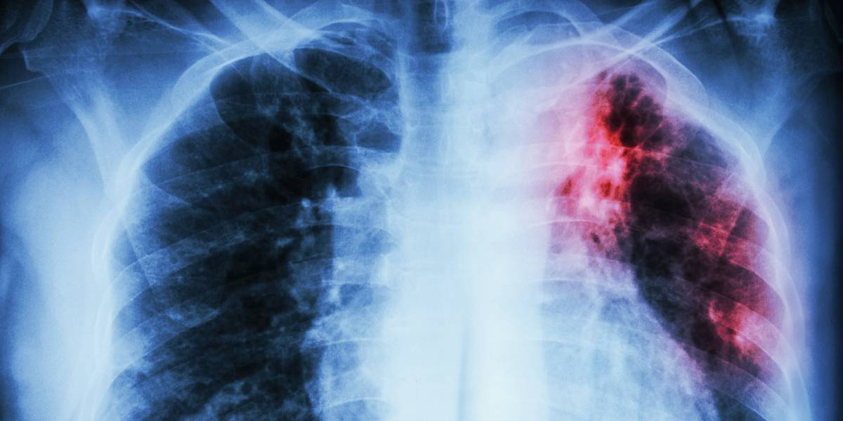 Можно ли лечить туберкулез легких амбулаторно и сколько дней держат в стационаре
