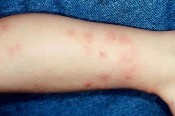 Аллергический дерматит у детей: симптомы, причины и правильное лечение
