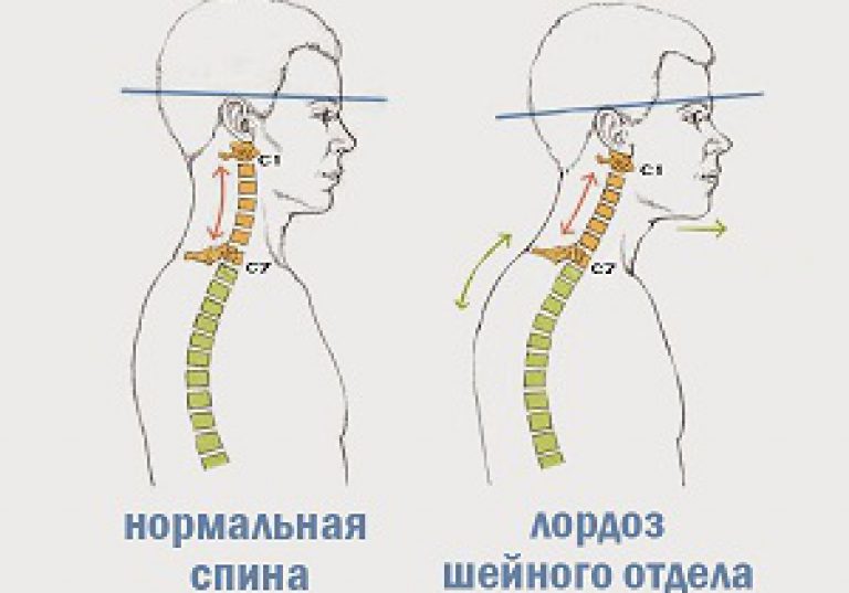 Поясничный лордоз фото