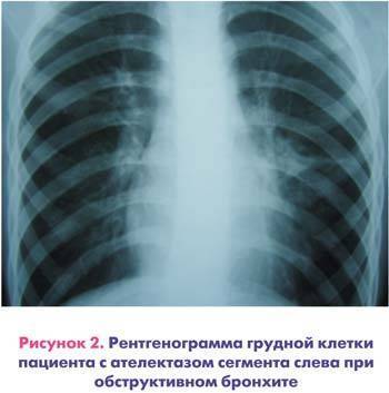 Бронхиолит у детей рентгенологическая картина