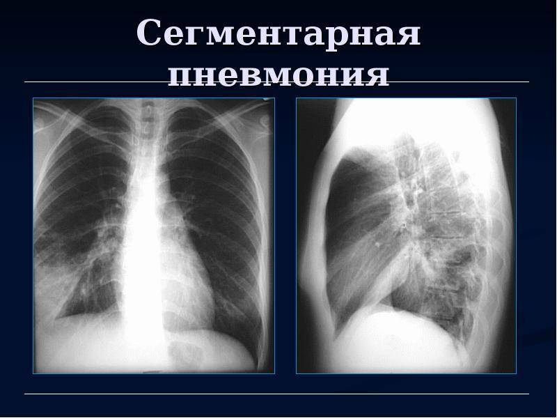 При кашле болит справа под ребрами сбоку что