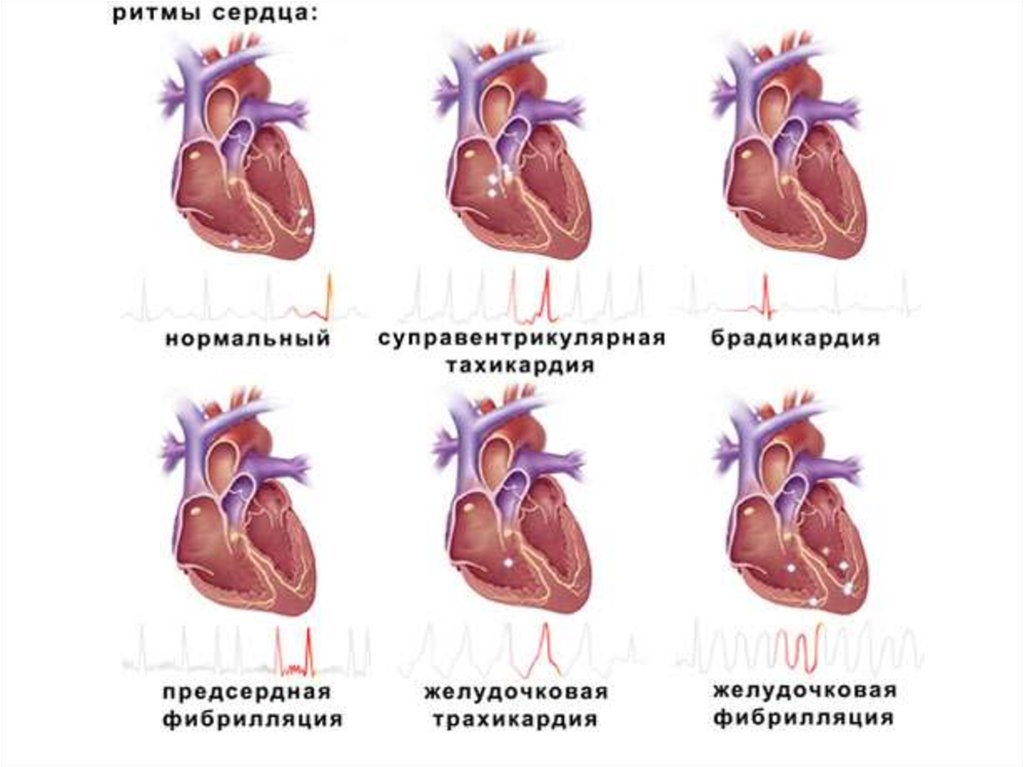 Аритмия сердца - причины, симптомы и лечение