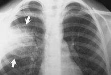Туберкулез и пневмония: сходство и различия