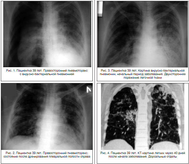 Двусторонняя пневмония снимок легких. Крупозная пневмония рентгенологическая картина. Крупозная и очаговая пневмония. Легкие кт 1