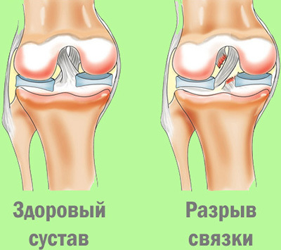 Растяжение связок коленного сустава  и их лечение в клинике доктора глазкова в москве