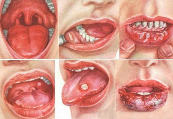 Язвы во рту: причины образования и способы лечение язв в полости рта