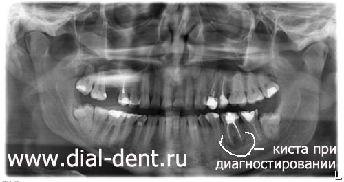 Опасность гранулемы корня зуба и способы лечения