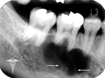 Что такое киста зуба и как ее вылечить