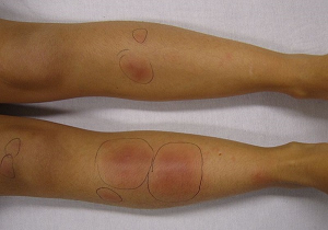 Узловатая эритема на ногах: лечение нижних конечностей и описание патологии
