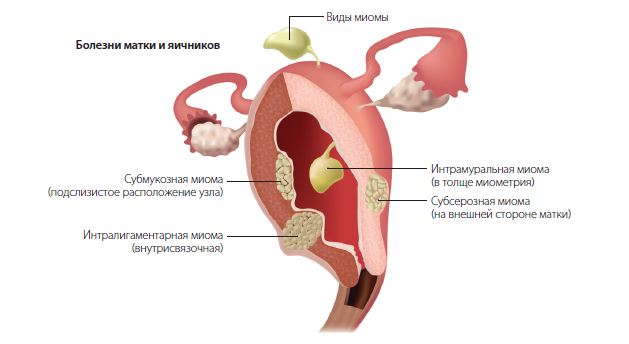 Аденомиоз матки 1 степени: причины, симптомы, лечение