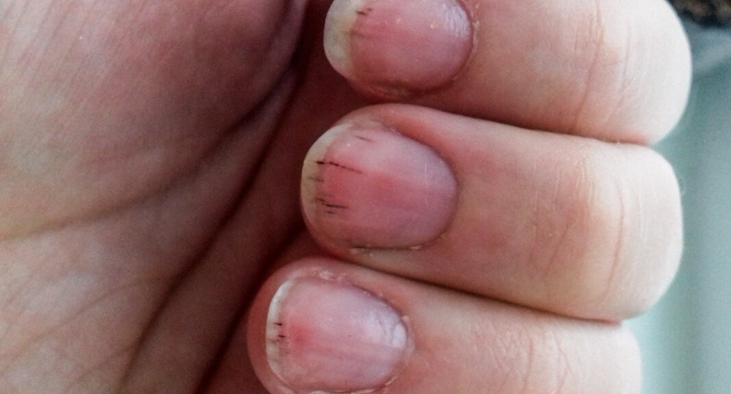 Болезни ногтей