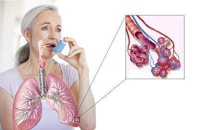 Обострение бронхиальной астмы: лечение и профилактика