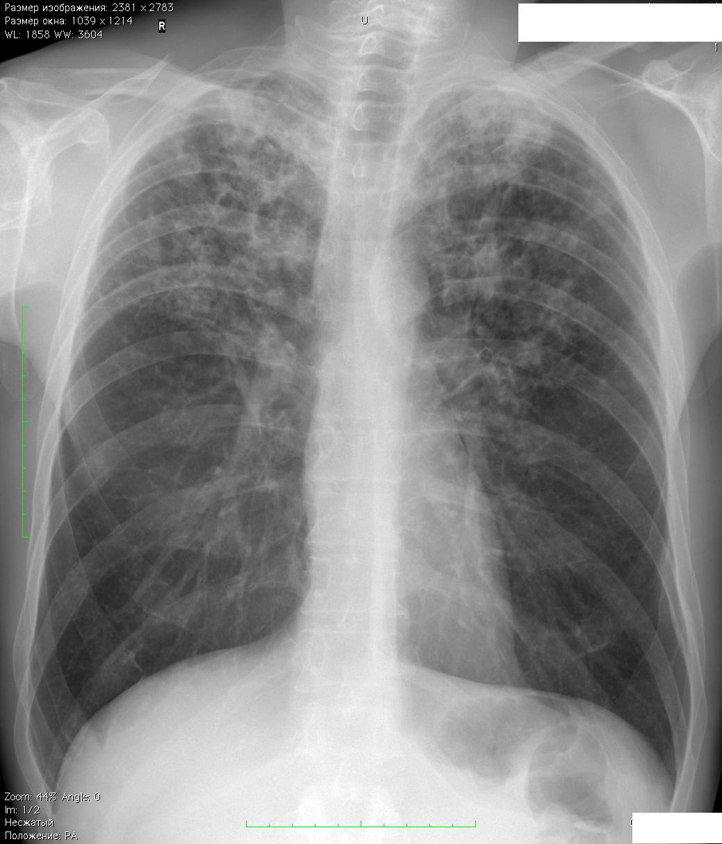 Основные признаки туберкулеза легких у взрослых