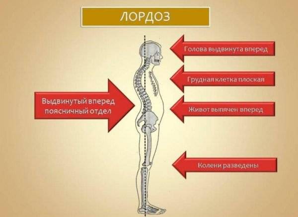 Умирают ли от искривления позвоночника?