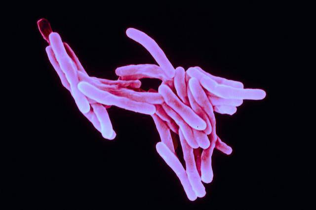 Основные признаки туберкулеза