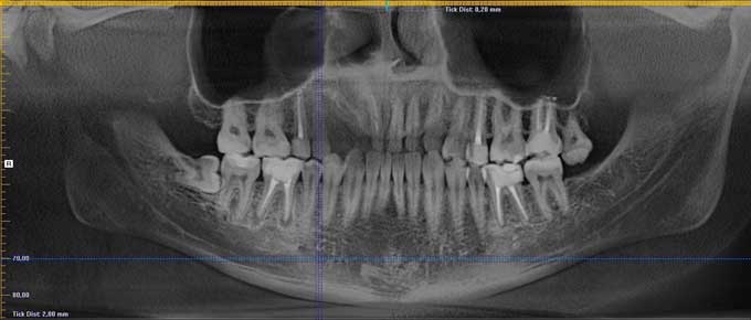 Гранулема или киста зуба