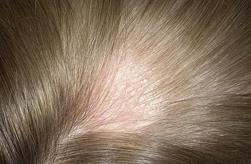 Грибок на голове: причины и разновидности поражений кожи, как избавиться от микоза у ребенка и взрослого народными средствами и препаратами
