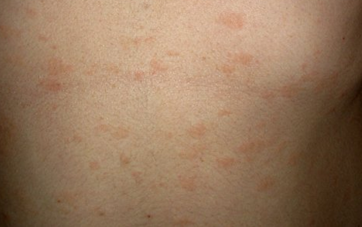 Сыпь на животе у взрослого человека: причины, симптомы, диагностика и лечение