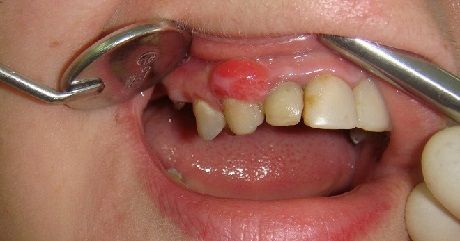 Как диагностируются и какими методами лечатся кисты зуба?