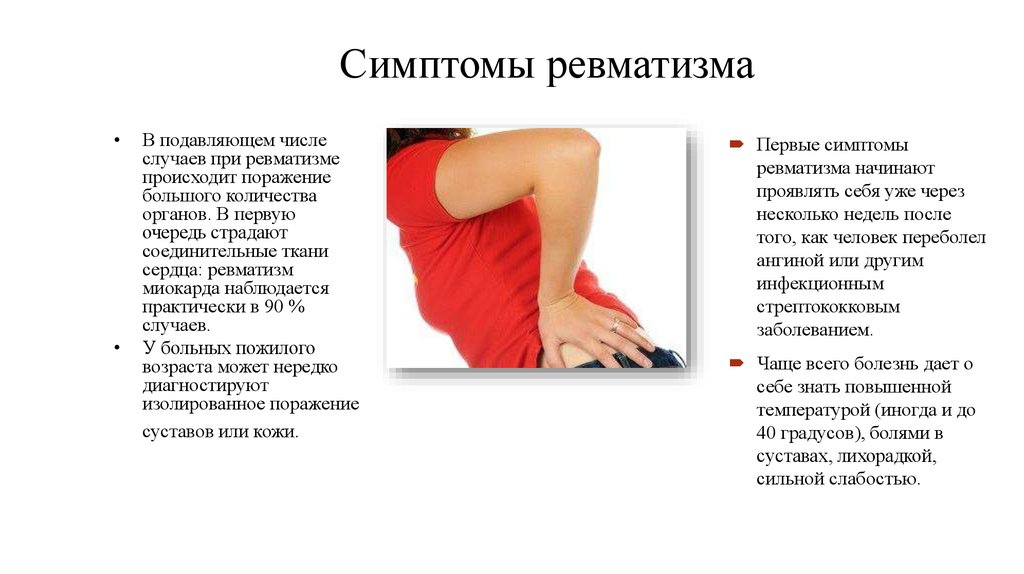 Ревматический артрит (ревматическая лихорадка)