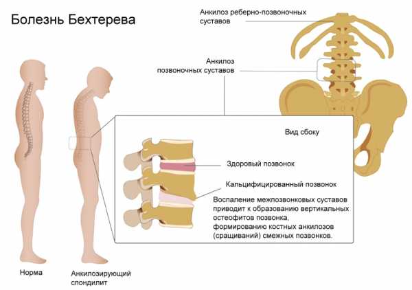 Туберкулезный спондилит: лечение, симптомы, причины, профилактика, диагностика | spinomed.ru