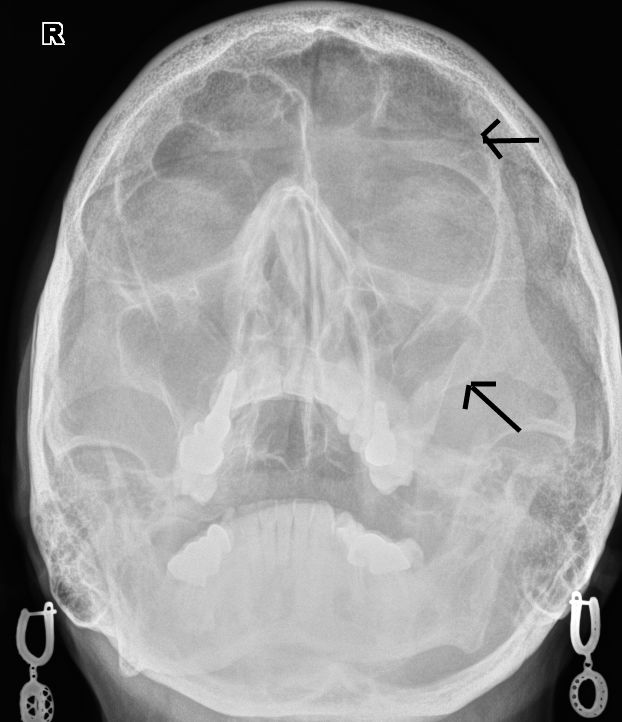 Диагноз фронтит. Катаральный фронтит рентген. Катаральный синусит рентген. Левосторонний гайморит рентген. Острый фронтит рентген.