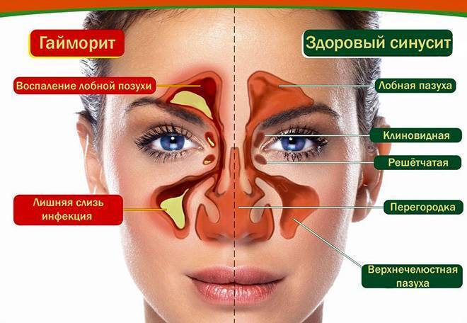 При гайморите желтые сопли что значит