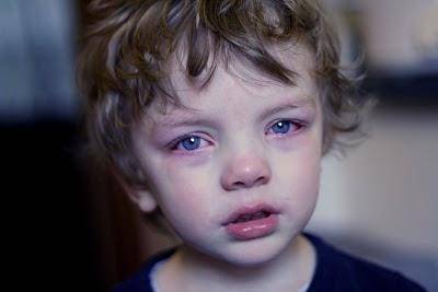 Эписклерит глаза, в том числе хронический у детей и взрослых, капли