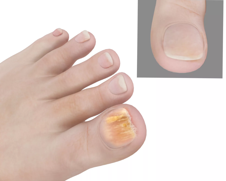 Грибок ногтей на ногах: чем лечить, самые эффективные средства