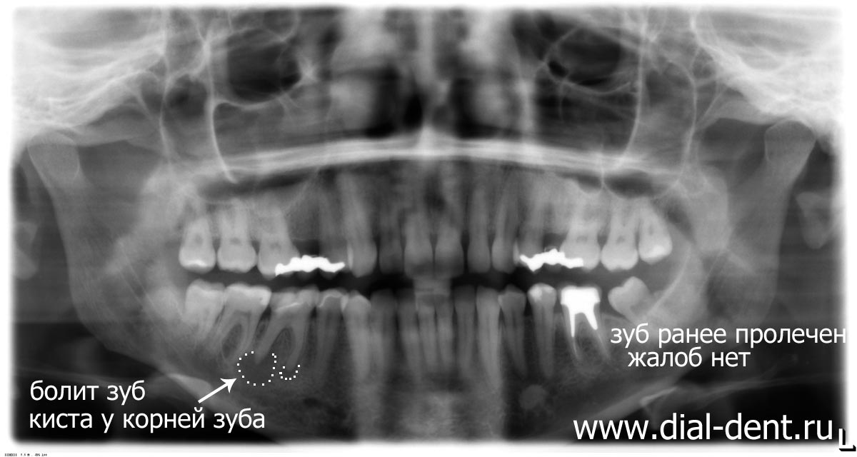 Киста в десне зуба: причины и симптомы, способы лечения