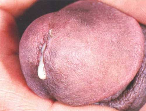 Выделения из уретры у мужчин: причины и лечение при желтых, гнойных выделениях из уретры