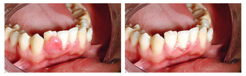 Киста и гранулема зуба причины симптомы диагностика лечение
