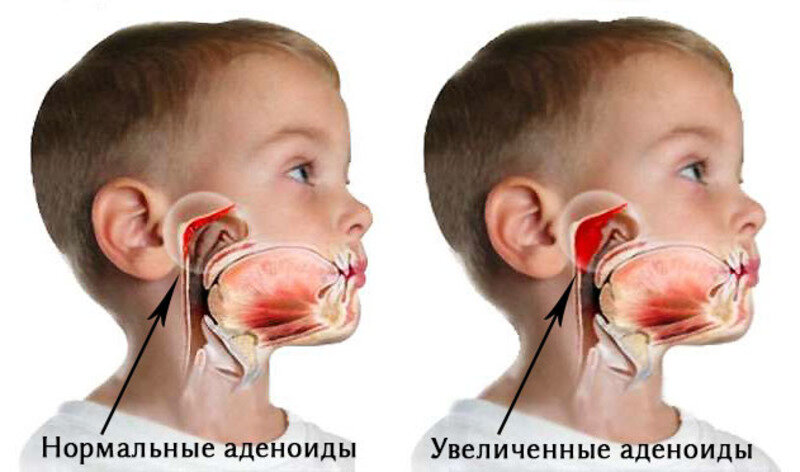Лечение аденоидов в носу у детей