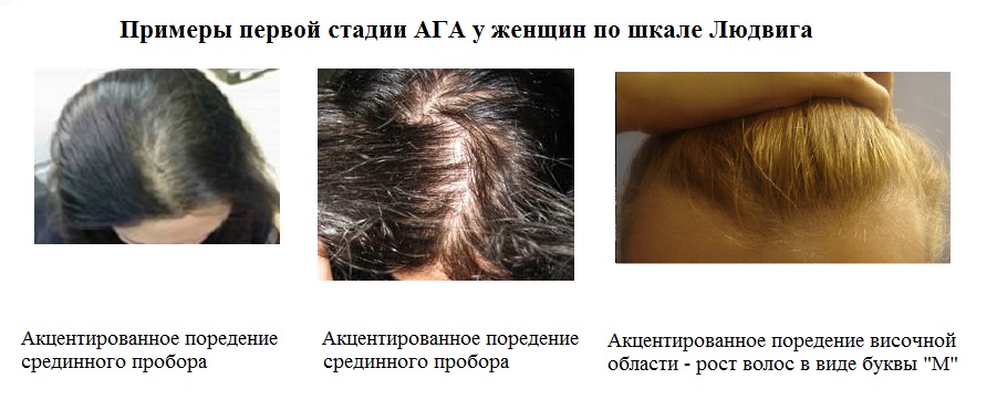 Если восстановить гормональный фон волосы перестают расти