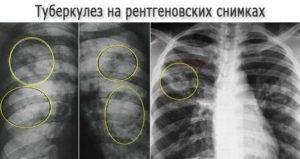 Рентген при туберкулезе легкого