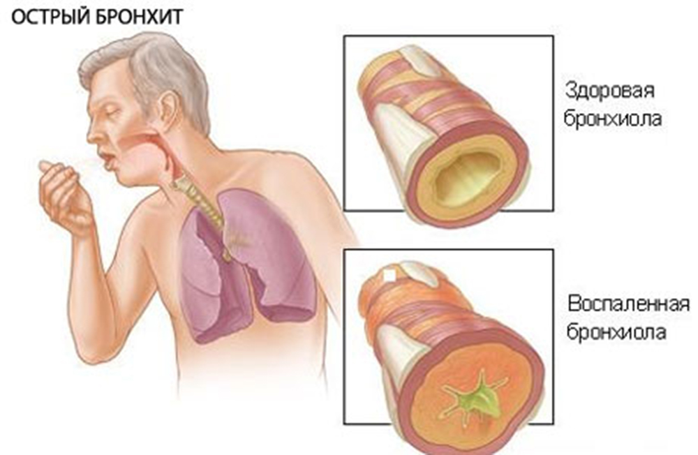 Хронический и острый бронхит презентация