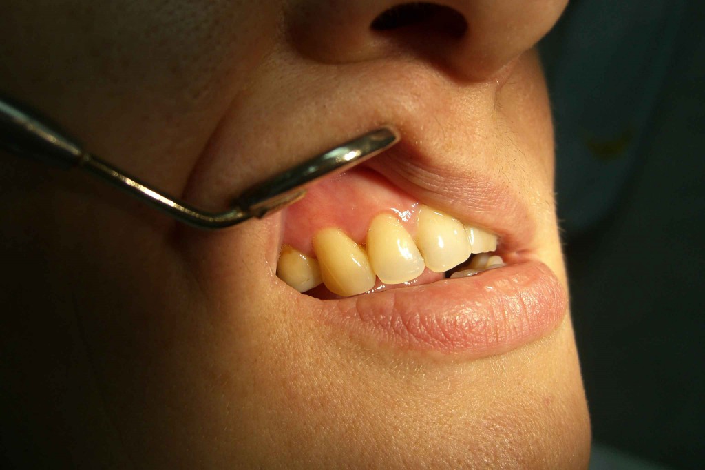Киста зуба – симптомы. киста на корне зуба – лечение или удаление?