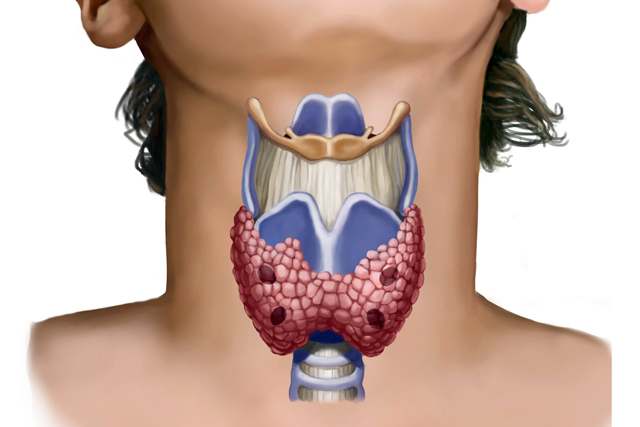Тиреоидит щитовидной железы
