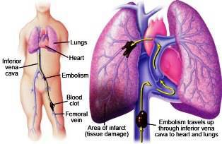 Тромбоэмболия легочной артерии: симптомы, лечение, диагностика тэла и осложнения