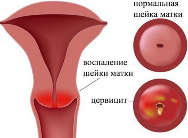 Противовоспалительные вагинальные свечи в гинекологии: обзор препаратов