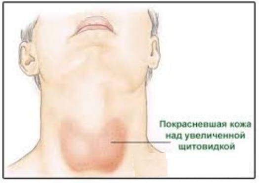 Причины и признаки увеличения щитовидной железы